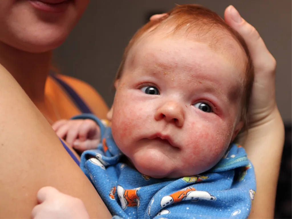 Tips for Soothing Your Child’s Eczema