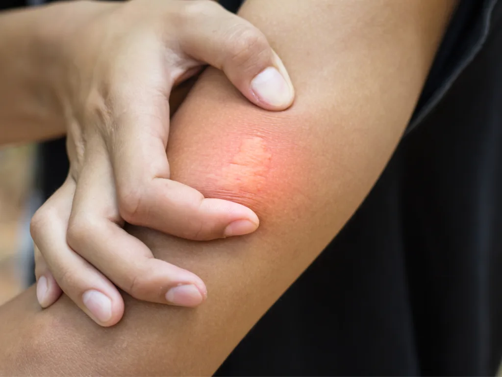 How to Recognize a Severe Allergic Reaction and What to Do About It